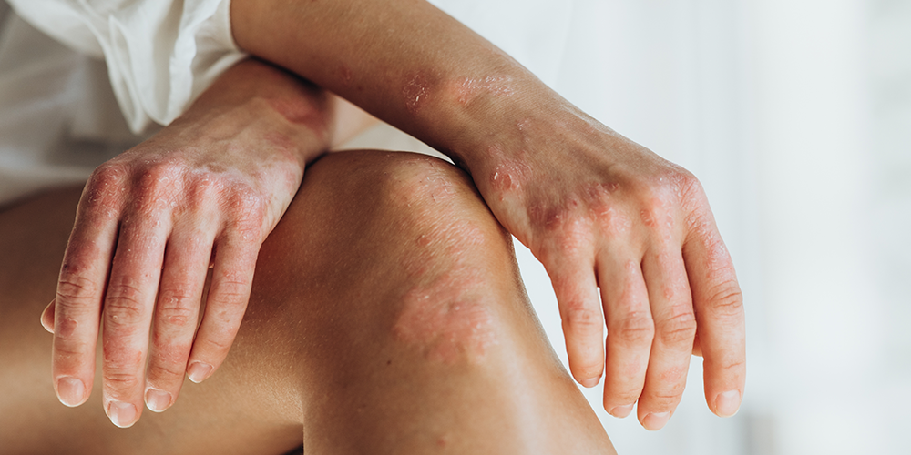 Eczema and dry skin care in winter