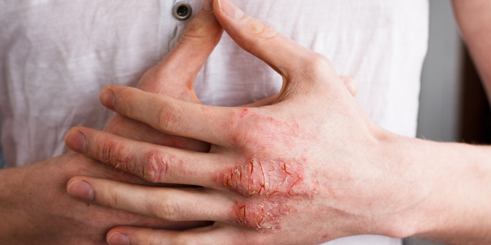 What is atopic dermatitis (and what can I do about it)