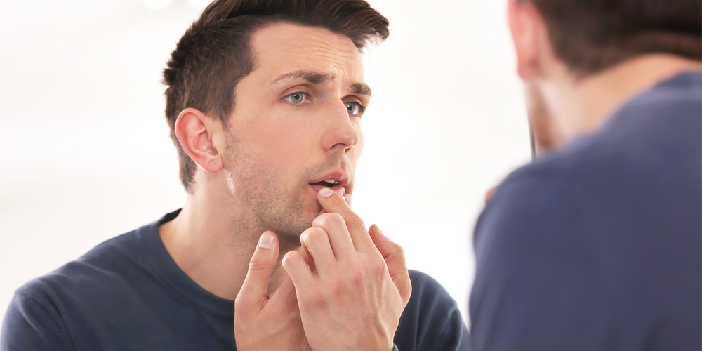 Cold sores 101