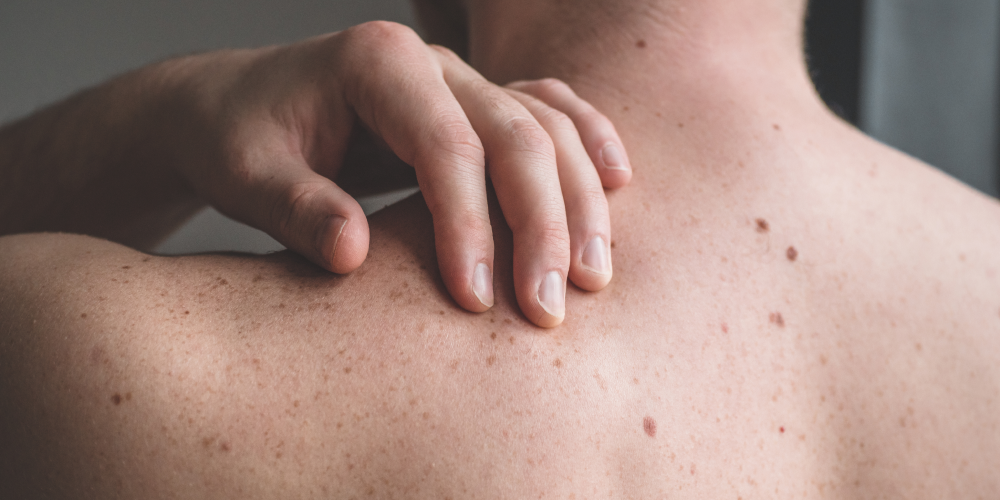 What is it like to experience melanoma?