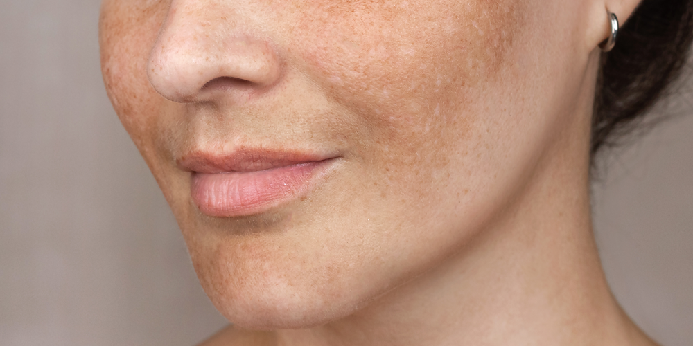 Want tips for hyperpigmentation and age spots? Read on