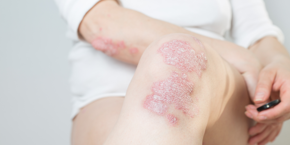 All about psoriasis: 10 questions, answered