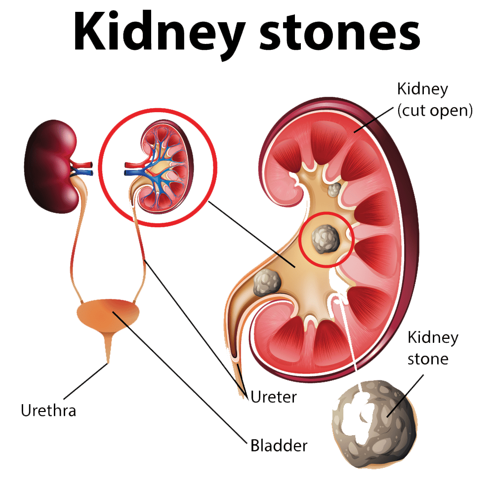 kidney stones symptoms