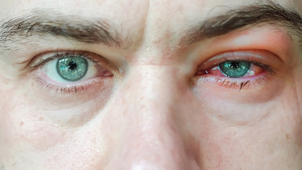 Can you prevent conjunctivitis