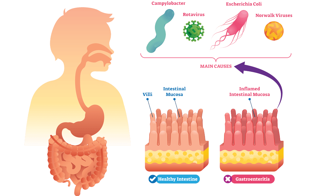 what causes gastro