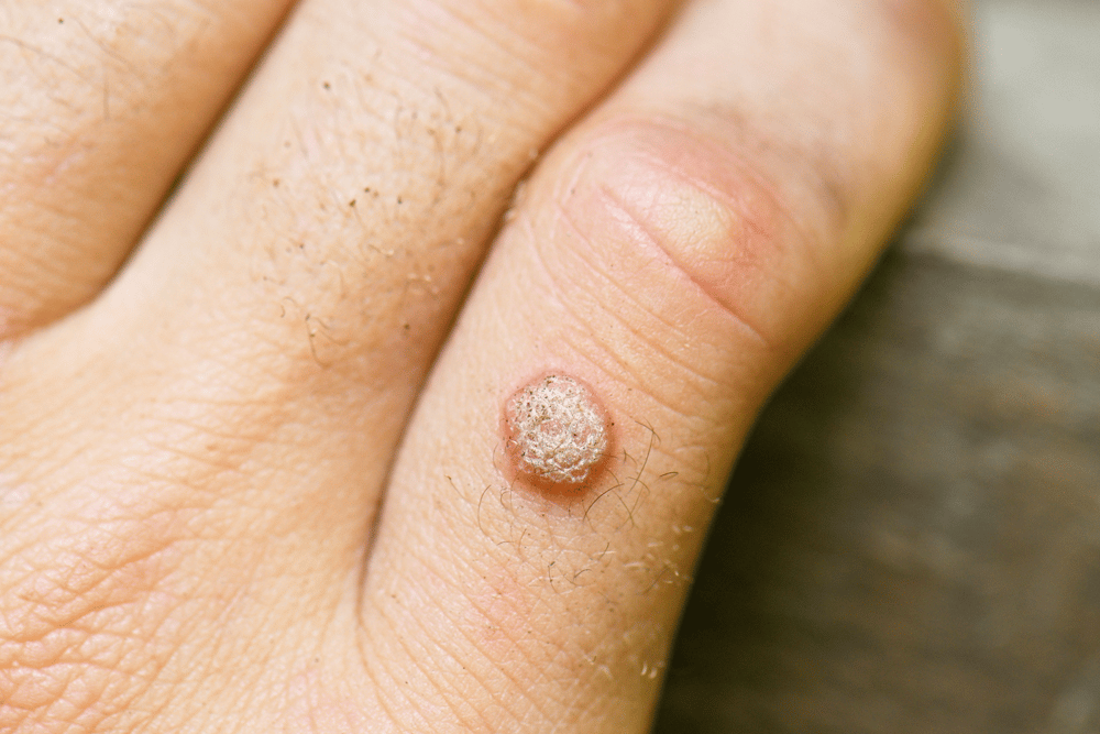 Types of warts and their symptoms