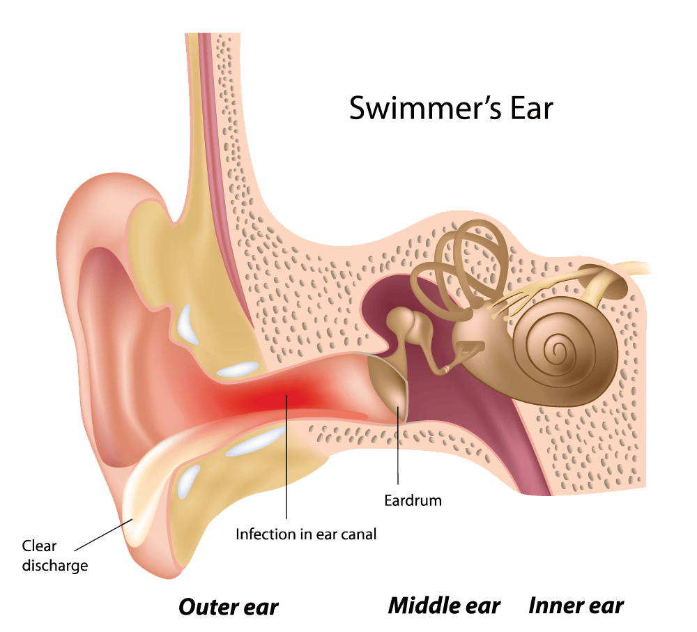 what causes swimmer's ear?