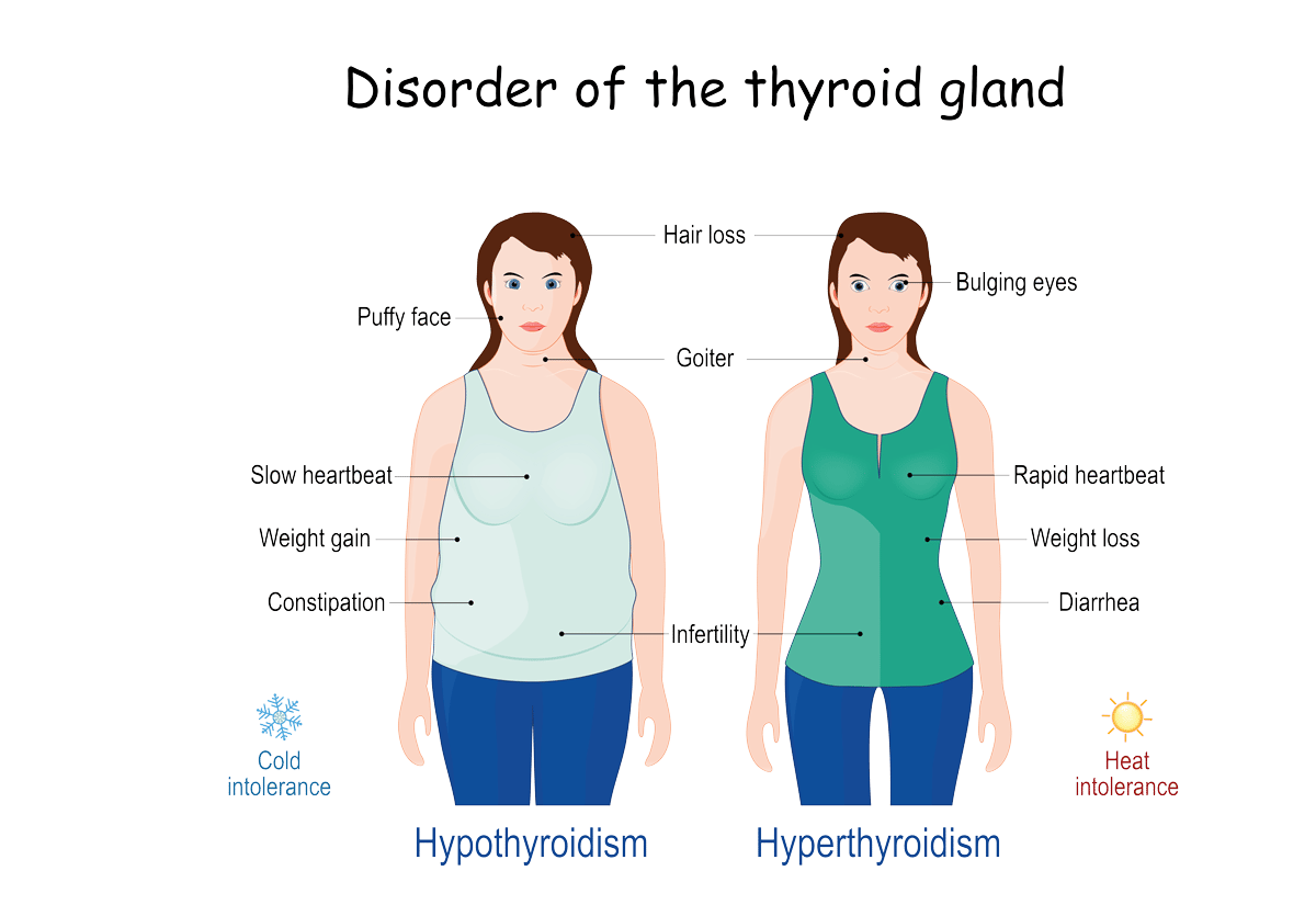 Disorder of the thyroid gland