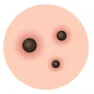 Blackheads