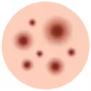 Cysts or nodules