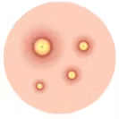 Pustules
