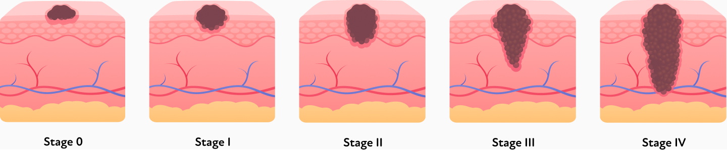 Stages of melanoma