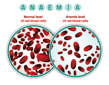 Anaemia