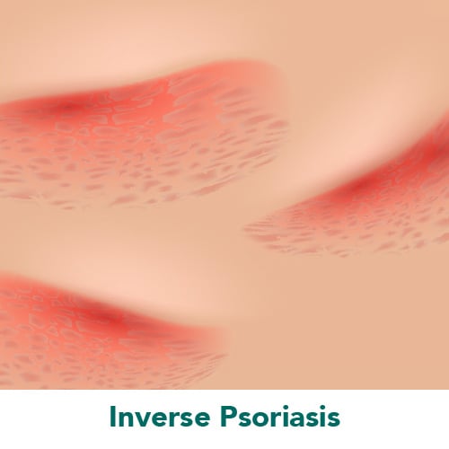 Inverse Psoriasis