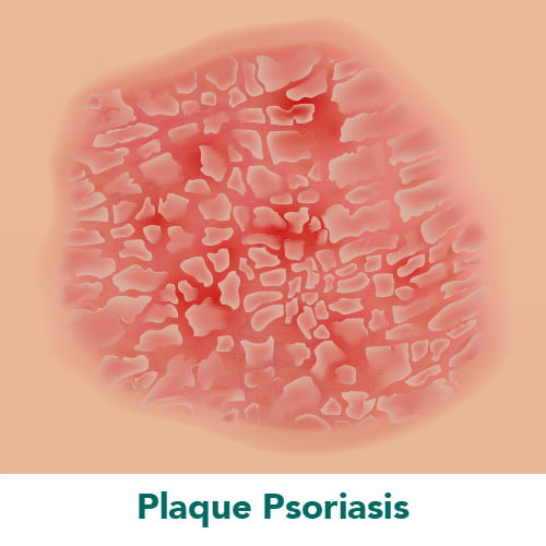 Plaque Psoriasis