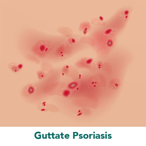 Guttate Psoriasis