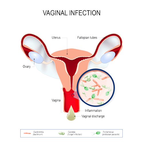 vaginal infection