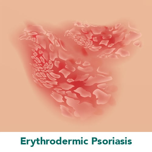 Erythrodermic Psoriasis