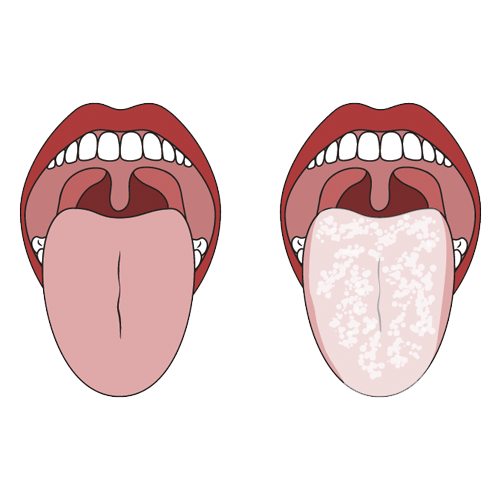 Oral infection