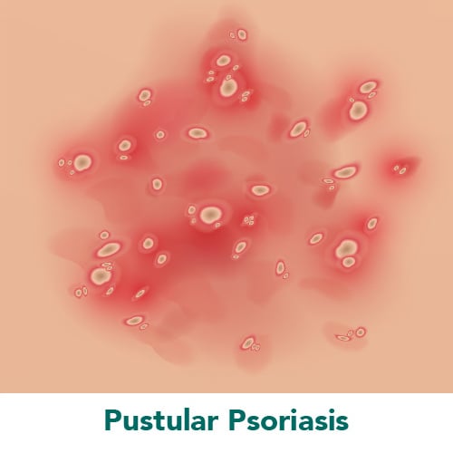 Pustular Psoriasis