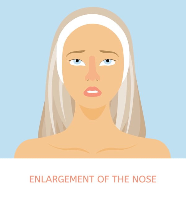 Phymatous Rosacea