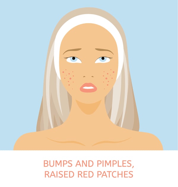 Erythematotelangiectatic Rosacea