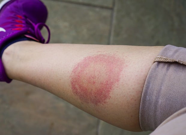 what are the symptoms of Lyme disease
