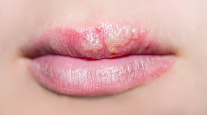 what causes cold sores