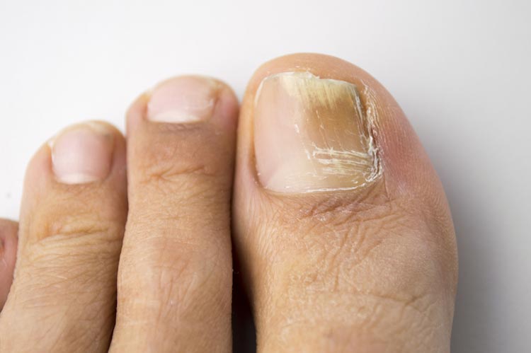 signs and symptoms of fungal nail infections