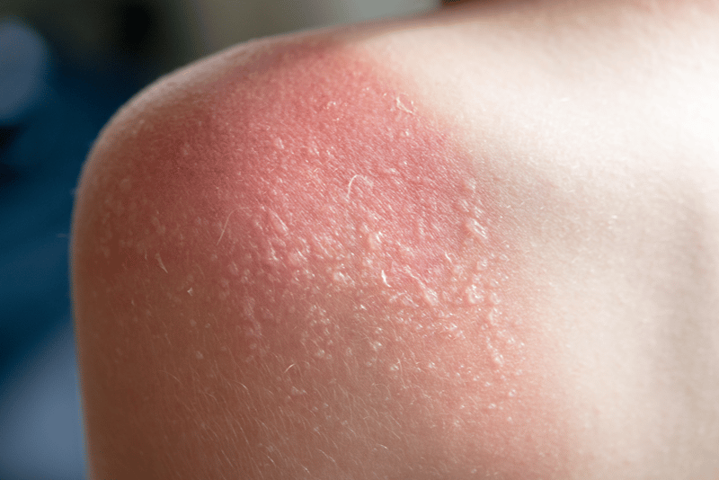 signs of sunburn