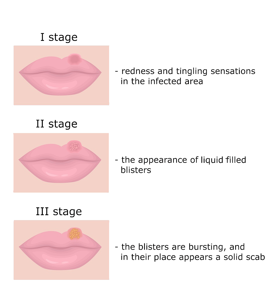 stages of herpes