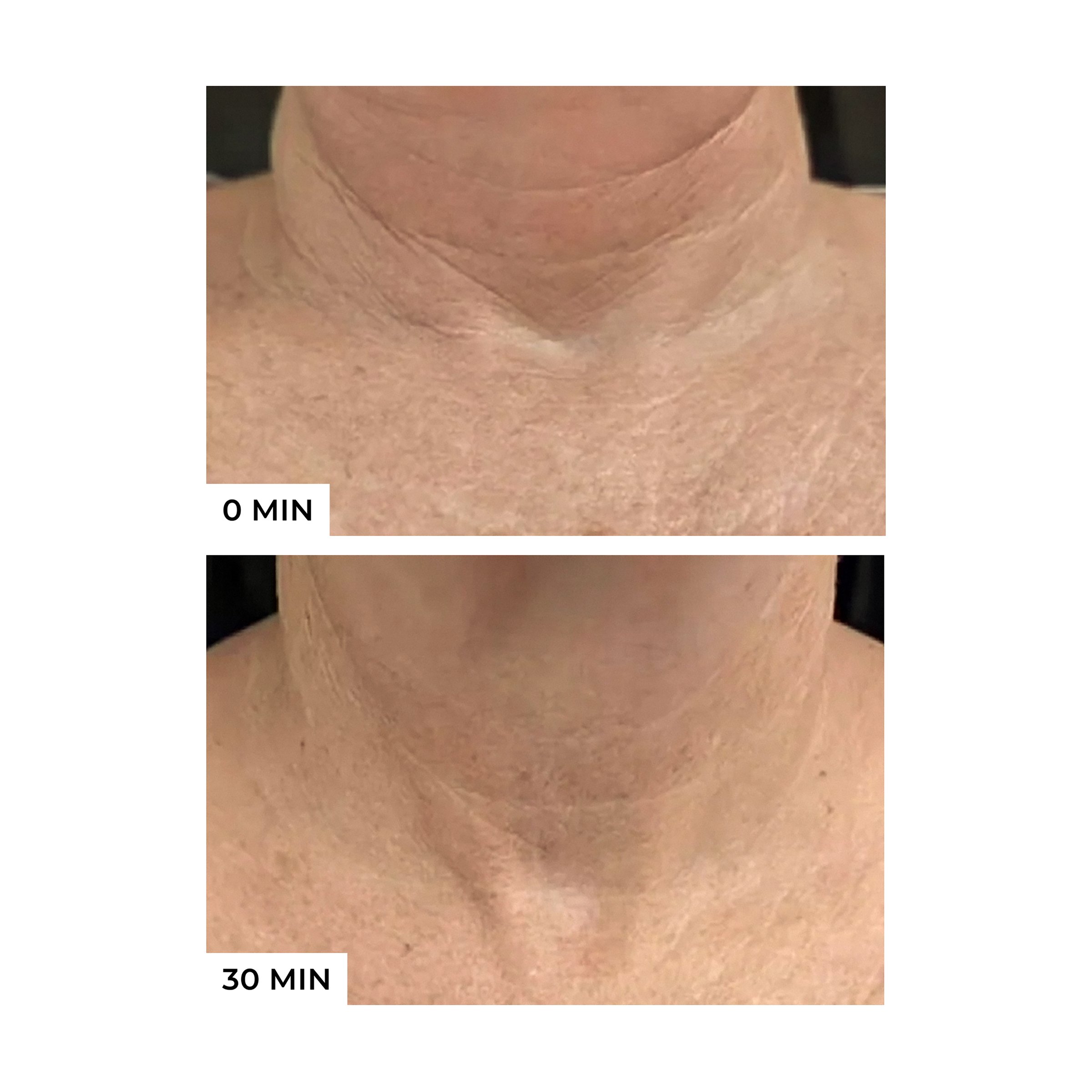 Freezeframe Neck Lift 50ml - Image 2