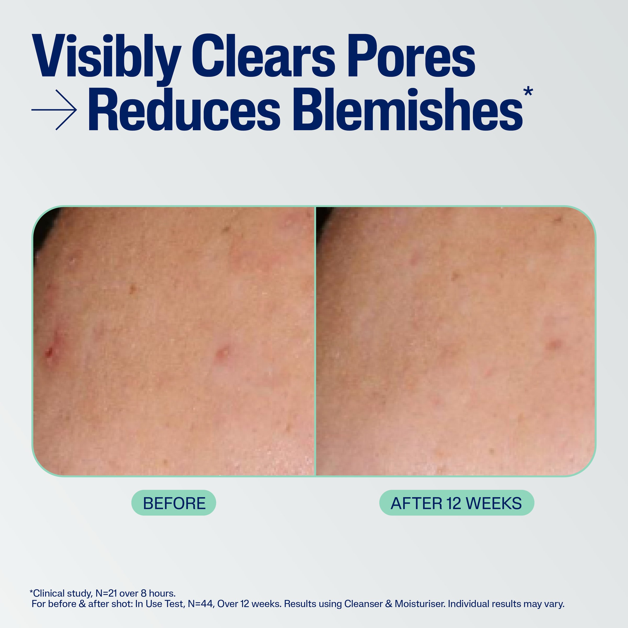 Cetaphil Blemish Cleanser 124ml - Image 10