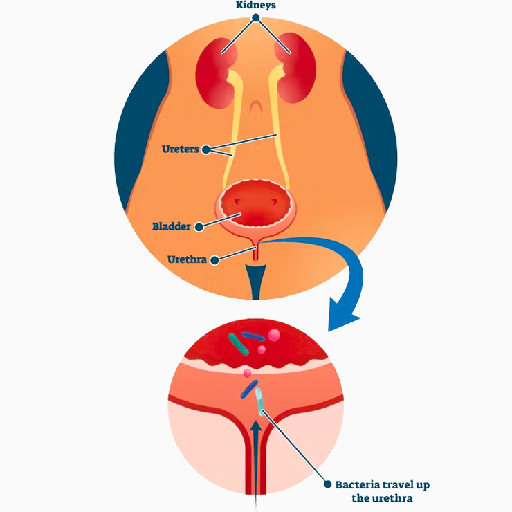 what is considered a microdose of tirzepatide 3- Month Micro-dosing Tirzepatide